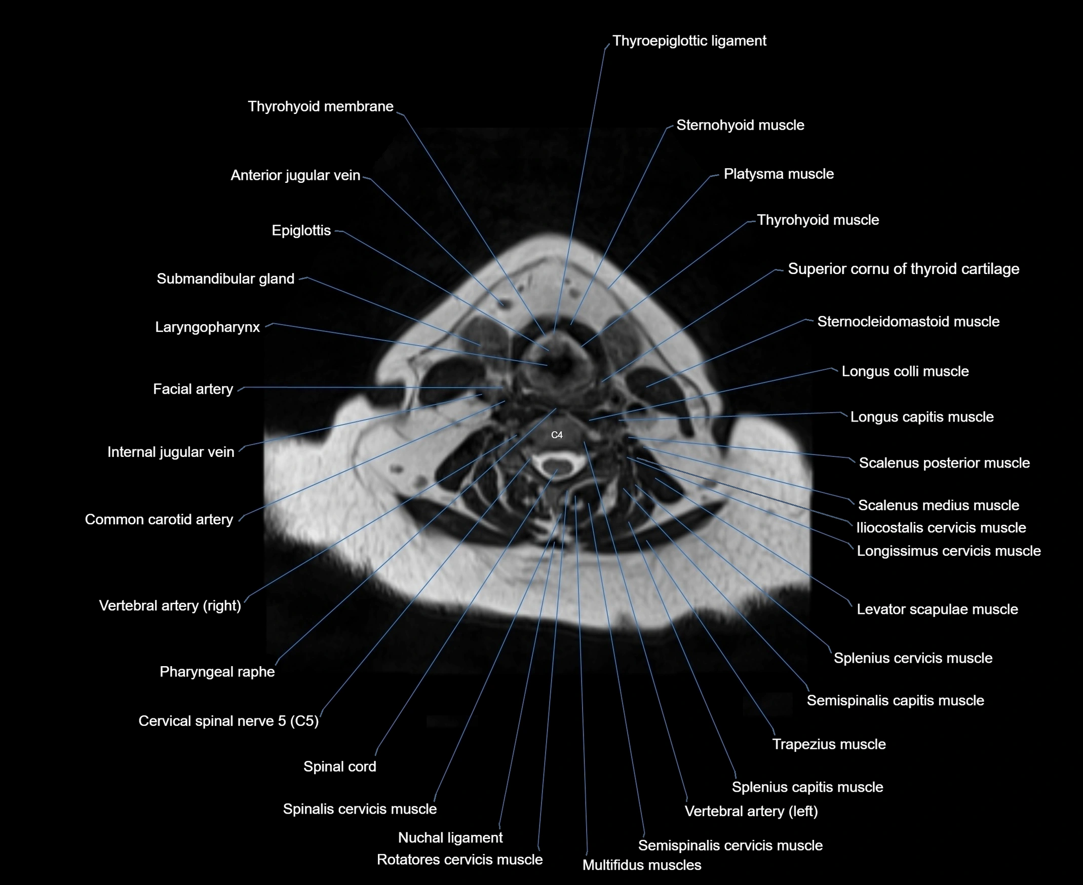 MRI Neck 3D labelled cross section anatomy axial 3t image-00001-00054.webp